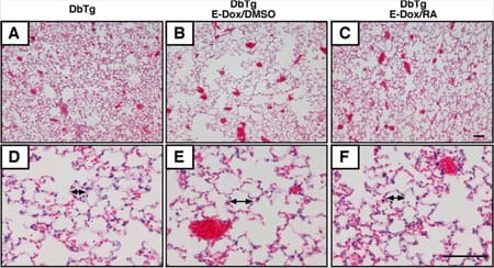 Retinoic acid rescues emphysema caused by prenatal FGFR-HFc expression.